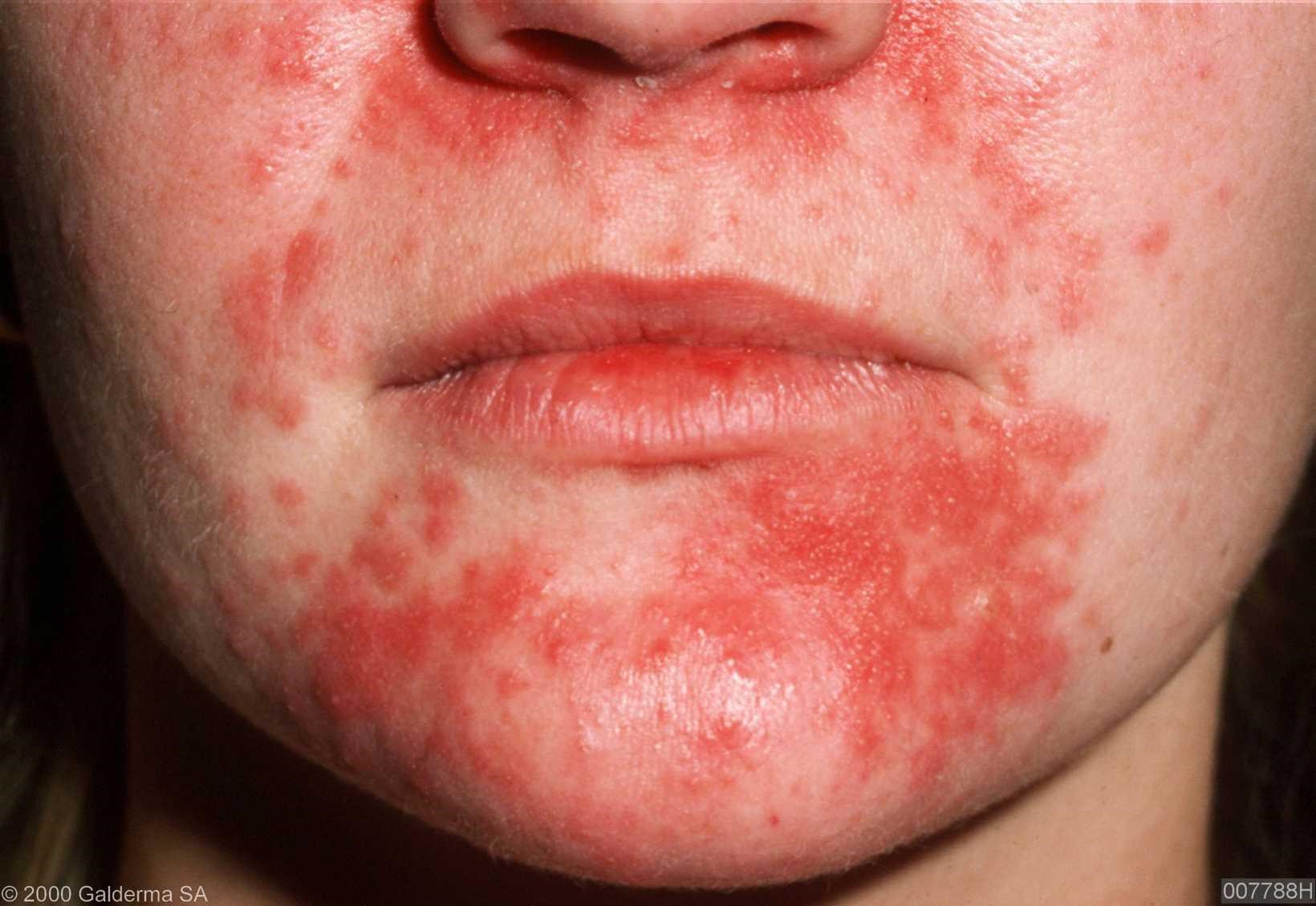 Sixteen Years of Painful Facial Breakouts and What Finally Brought ...